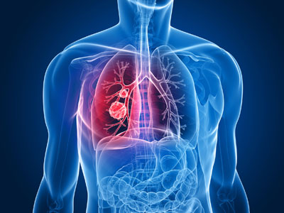La nanotecnologa detectar precozmente el cncer de pulmn gracias a un proyecto financiado por la AECC