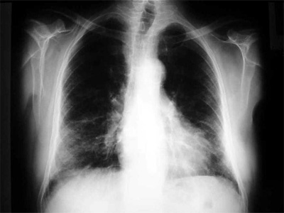 Noticia de Almera 24h: La universidad y el Hospital Torrecrdenas definen el escenario cientfico actual en torno a la tuberculosis 